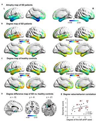 Brain Network for the Core Deficits of Semantic Dementia: A Neural Network Connectivity-Behavior Mapping Study
